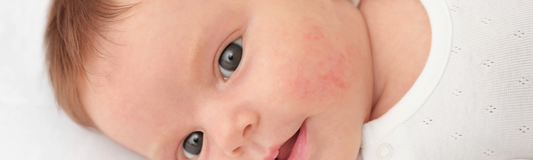 L'eczéma chez le nourrisson : comprendre, prévenir et agir